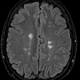 A MRI image of the brain showing multiple sclerosis plaques